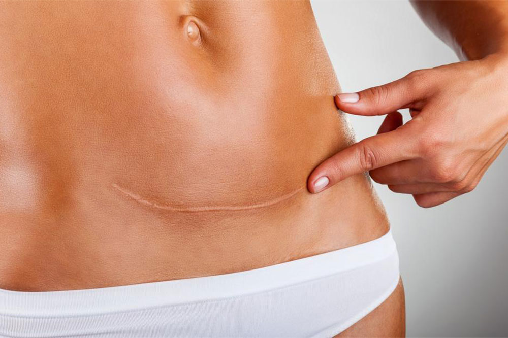 Ovarian Cancer – Signs and Diagnosis Methods
