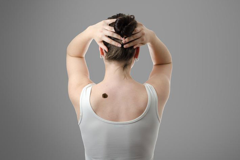 Early Signs and Stages of Skin Cancer