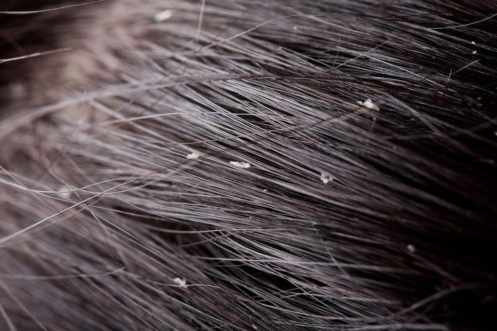 Home Remedies to Treat Flaky Scalp