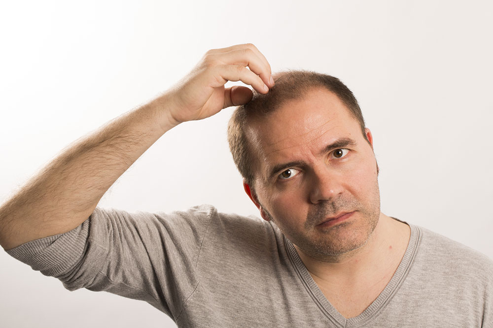Tips to Treat Male Pattern Baldness