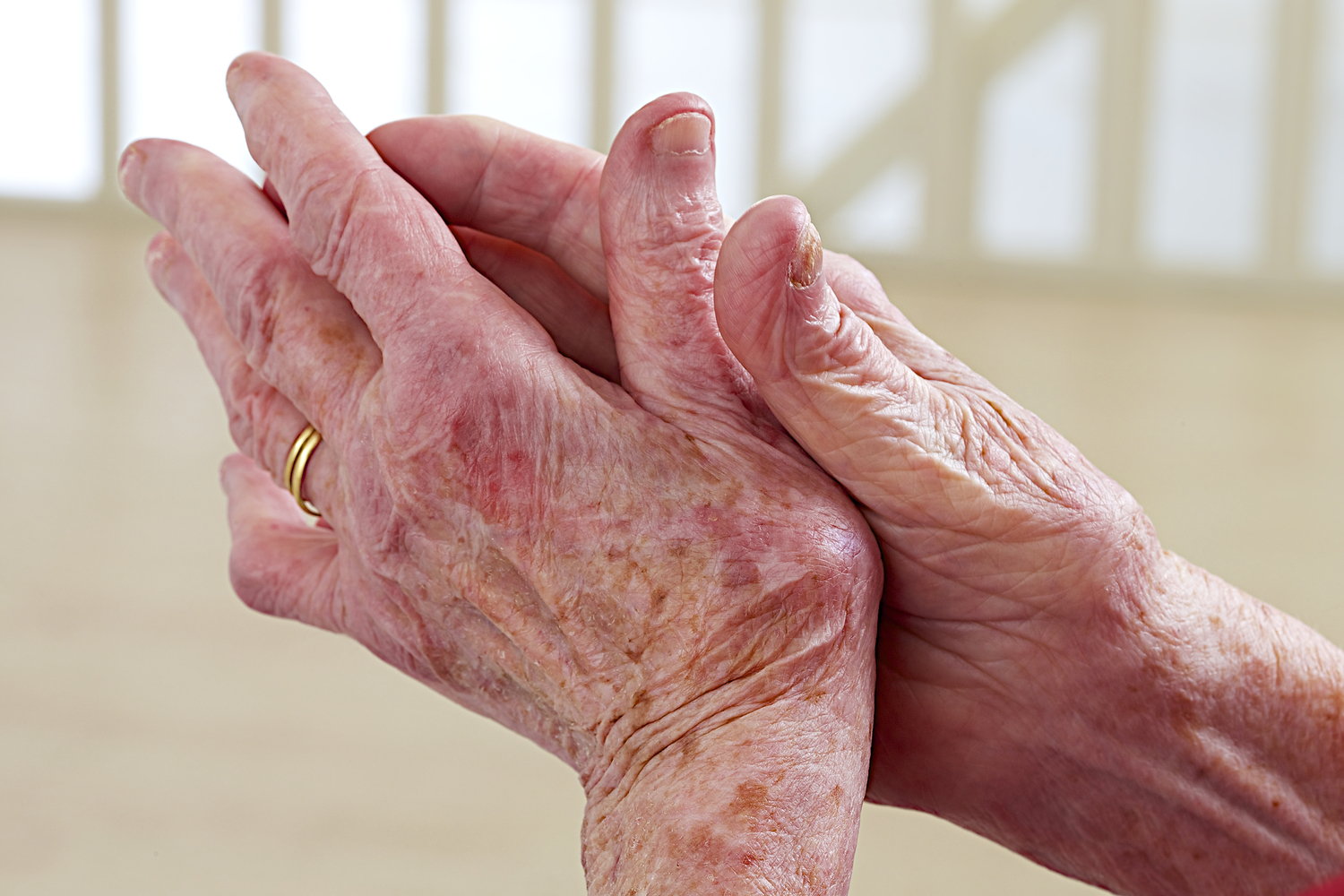 Common Signs of Lupus